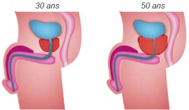 hypertrophie bénigne