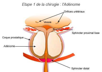 Etape 1 de la chirurgie : Adénome