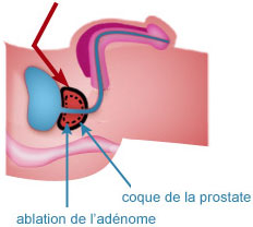 Adénomectomie