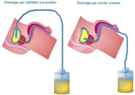 Drainage urine