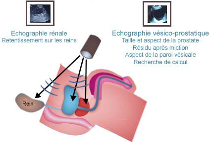 Échographie de la prostate