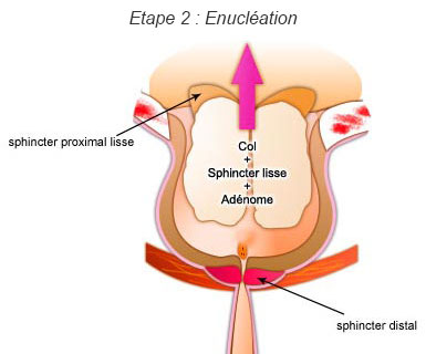 Etape 2 de la chirurgie : Enucléation