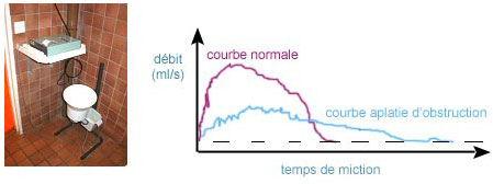 Graphique débit urinaire