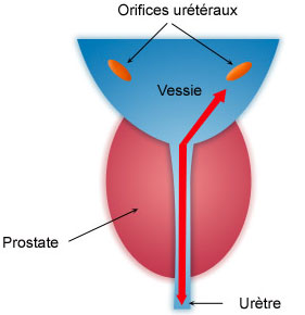 Incision cervico-prostatique