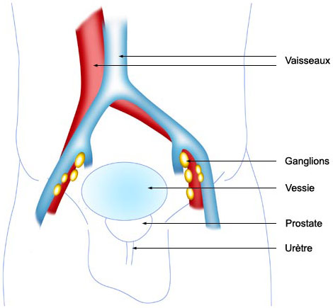 Prostatectomie