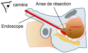 Résection endoscopique de prostate