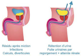 L'Incontinence Urinaire chez l'Homme après une Prostatectomie