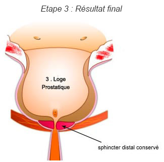 Etape 3 de la chirurgie : Résultat final