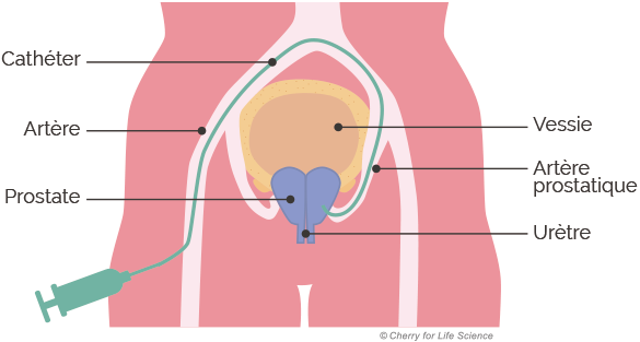 prostate embolisation traitement