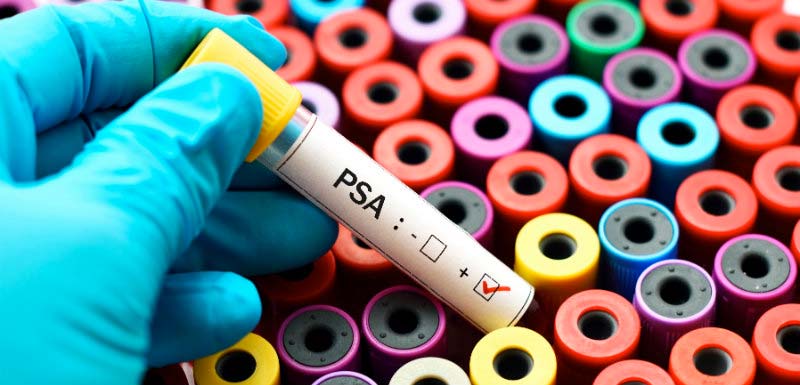 Cancer de la prostate : le marqueur PSA bientôt remplacé ?!