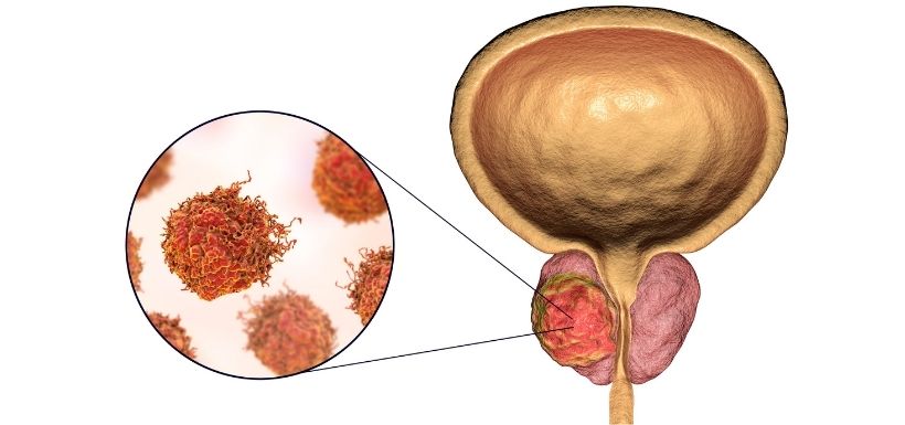 Cancer de la prostate : un lien avec les bactéries intestinales